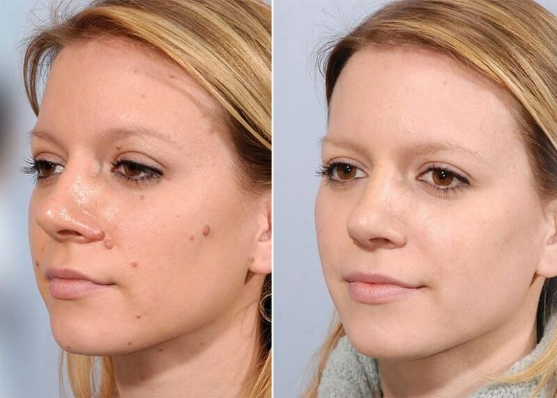 Mole Removal Home