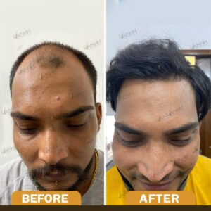 Hair Transplant in delhi